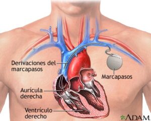 ¿Que es un marcapasos en el corazon? 3